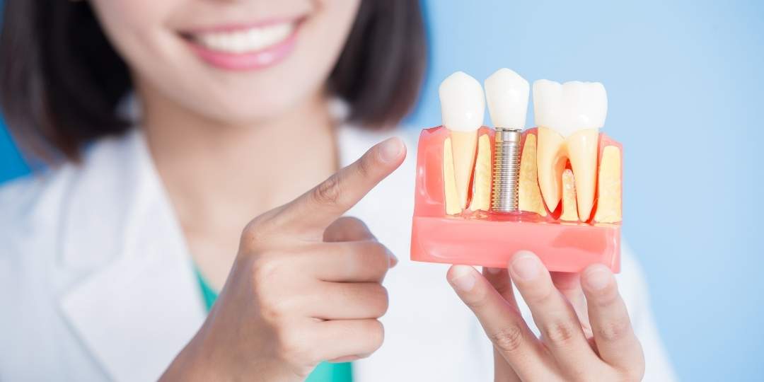 Prótesis dentales removibles lo último