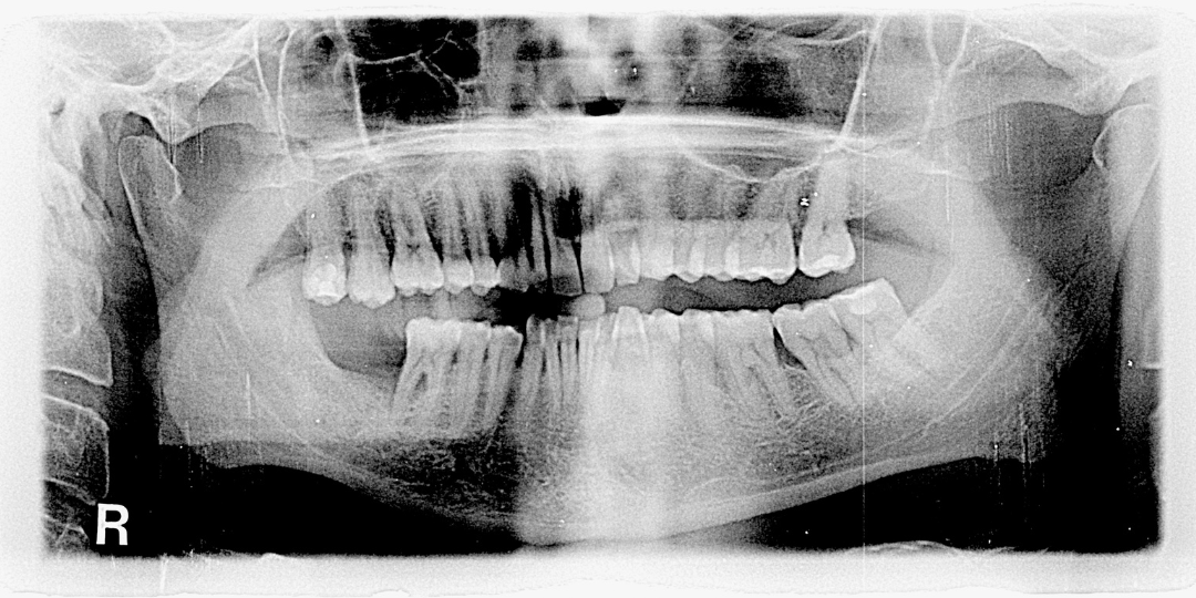 Clínica Dental para ponerme una prótesis dental sin ganchos en Alcorcón